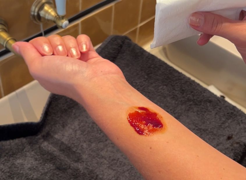 Iodine jodiumtekort test op huid (1)